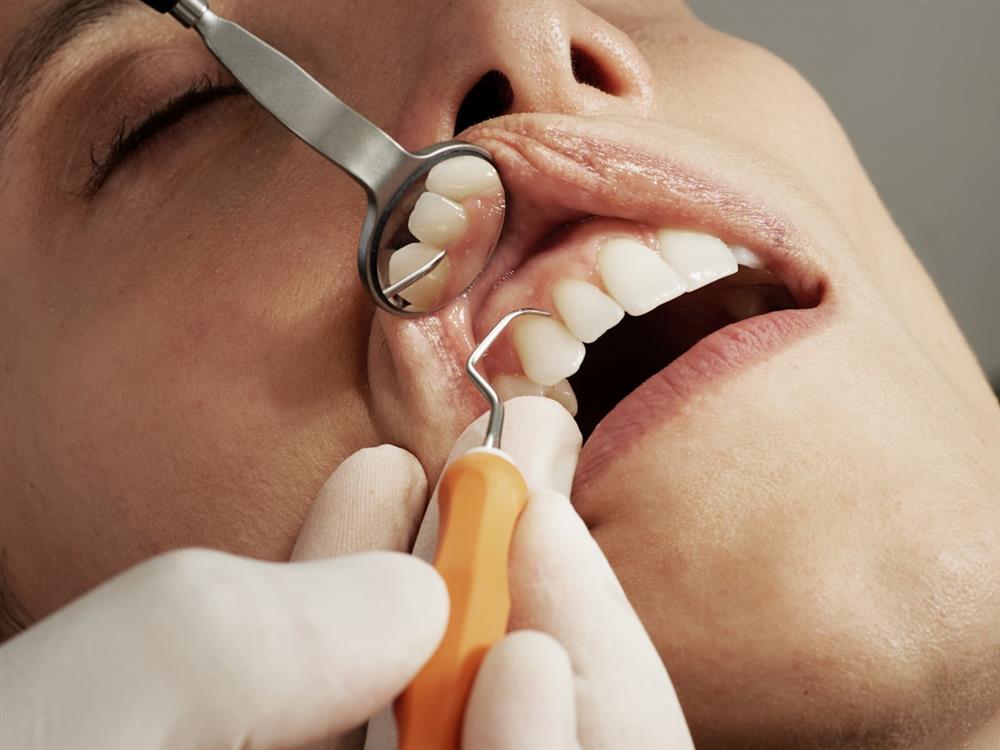 A periodontal probe measuring the gumline during an exam